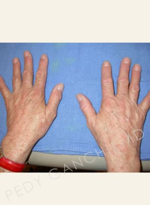 Hand Rejuvenation