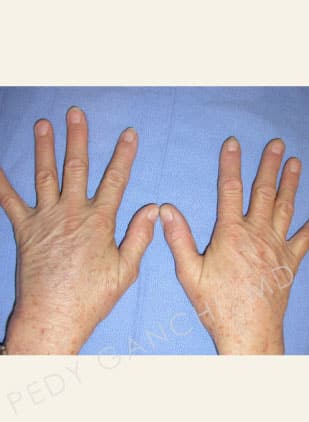 Hand Rejuvenation