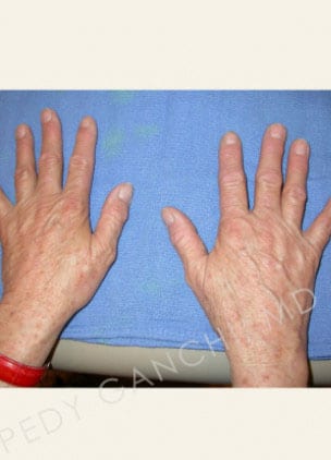 Hand Rejuvenation