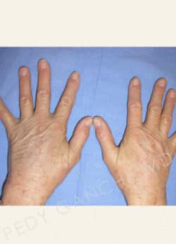 Hand Rejuvenation