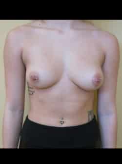 Breast Augmentation (Implants)