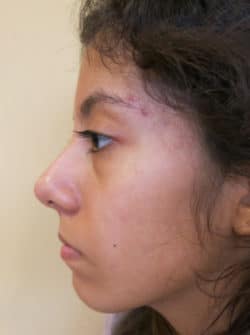 Nasal - Rhinoplasty