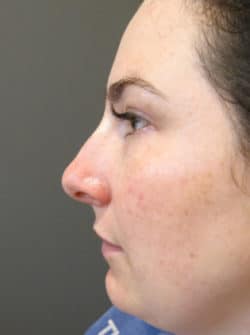 Nasal - Rhinoplasty