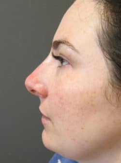 Nasal - Rhinoplasty