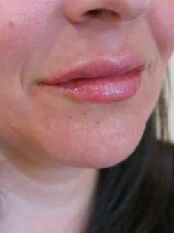 Lip Augmentation