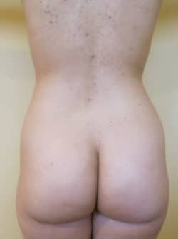 Liposuction