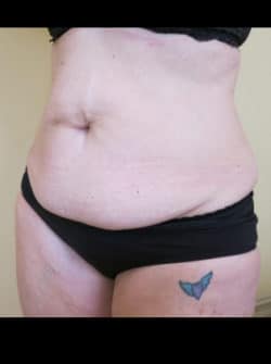 Tummy Tuck