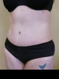 Tummy Tuck