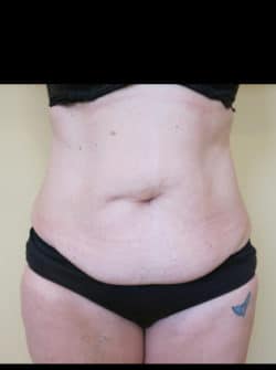 Tummy Tuck