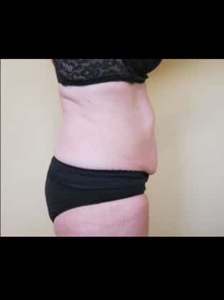 Tummy Tuck