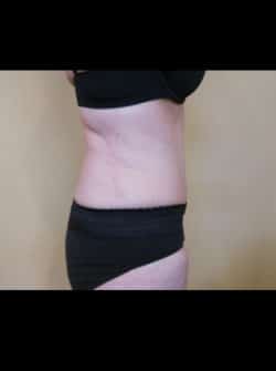 Tummy Tuck