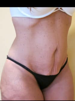 Tummy Tuck