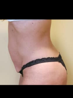 Tummy Tuck