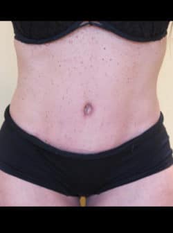 Tummy Tuck