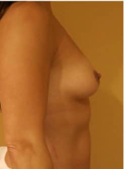 Breast Augmentation (Implants)