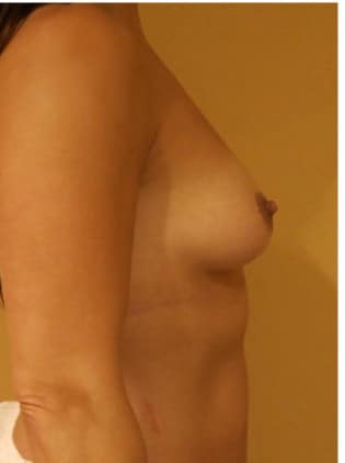 Breast Augmentation (Implants)