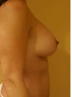 Breast Augmentation (Implants)