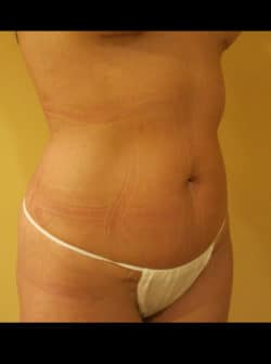 Tummy Tuck