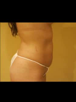 Tummy Tuck