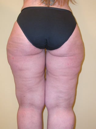 Liposuction