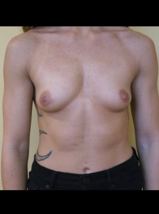 Breast Augmentation (Implants)