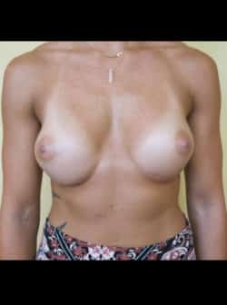 Breast Augmentation (Implants)