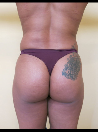 Brazilian Buttocks Lift (BBL)
