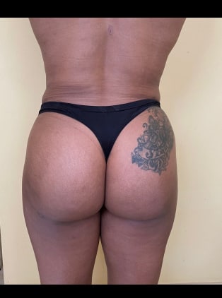 Brazilian Buttocks Lift (BBL)