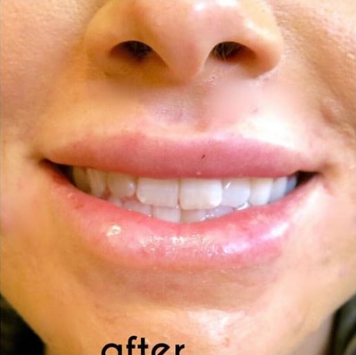 Lip Augmentation