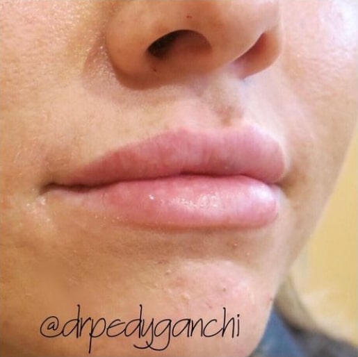 Lip Augmentation