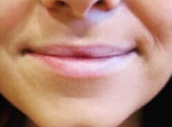 Lip Augmentation