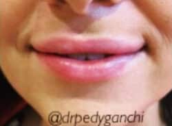 Lip Augmentation