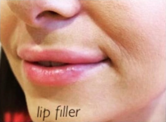 Lip Augmentation