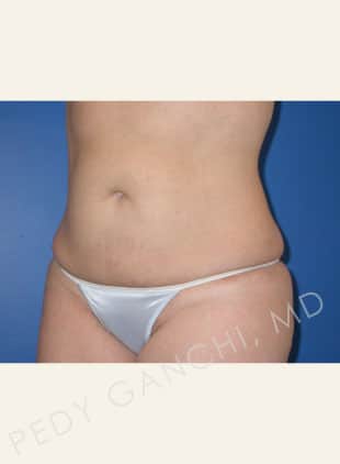 Liposuction