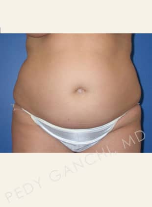 Liposuction