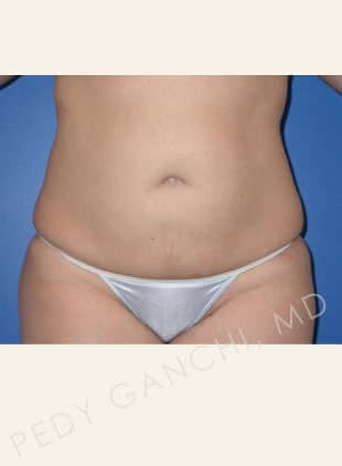 Liposuction