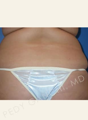 Liposuction