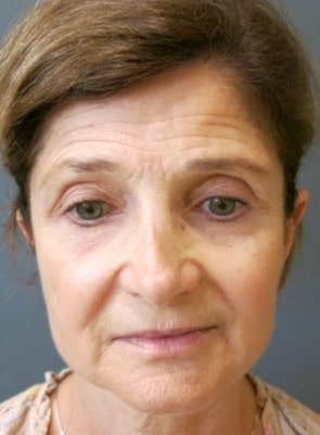 Face / Neck Lift