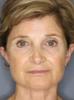 Face / Neck Lift