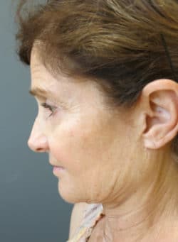 Face / Neck Lift