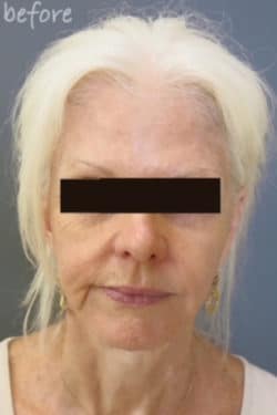 Face / Neck Lift