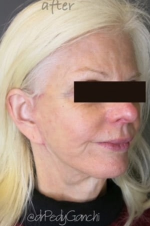 Face / Neck Lift