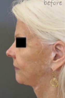 Face / Neck Lift