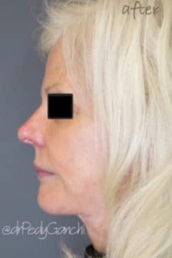 Face / Neck Lift