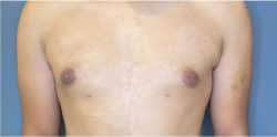 Gynecomastia (male breast reduction)