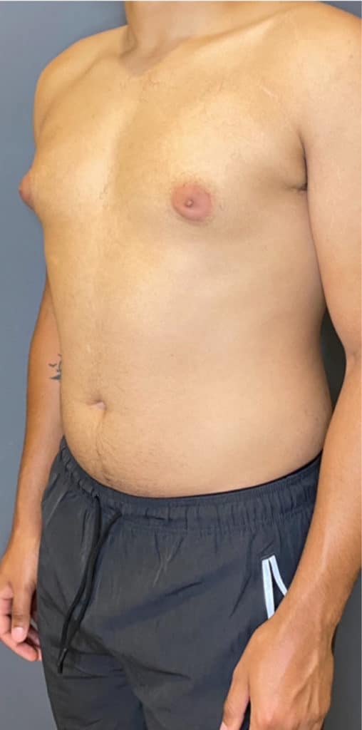 Gynecomastia (male breast reduction)