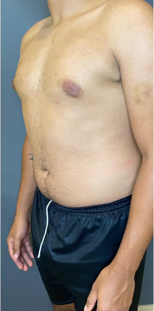 Gynecomastia (male breast reduction)