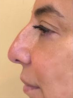Nasal - Rhinoplasty