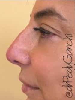 Nasal - Rhinoplasty