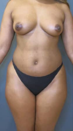 Liposuction